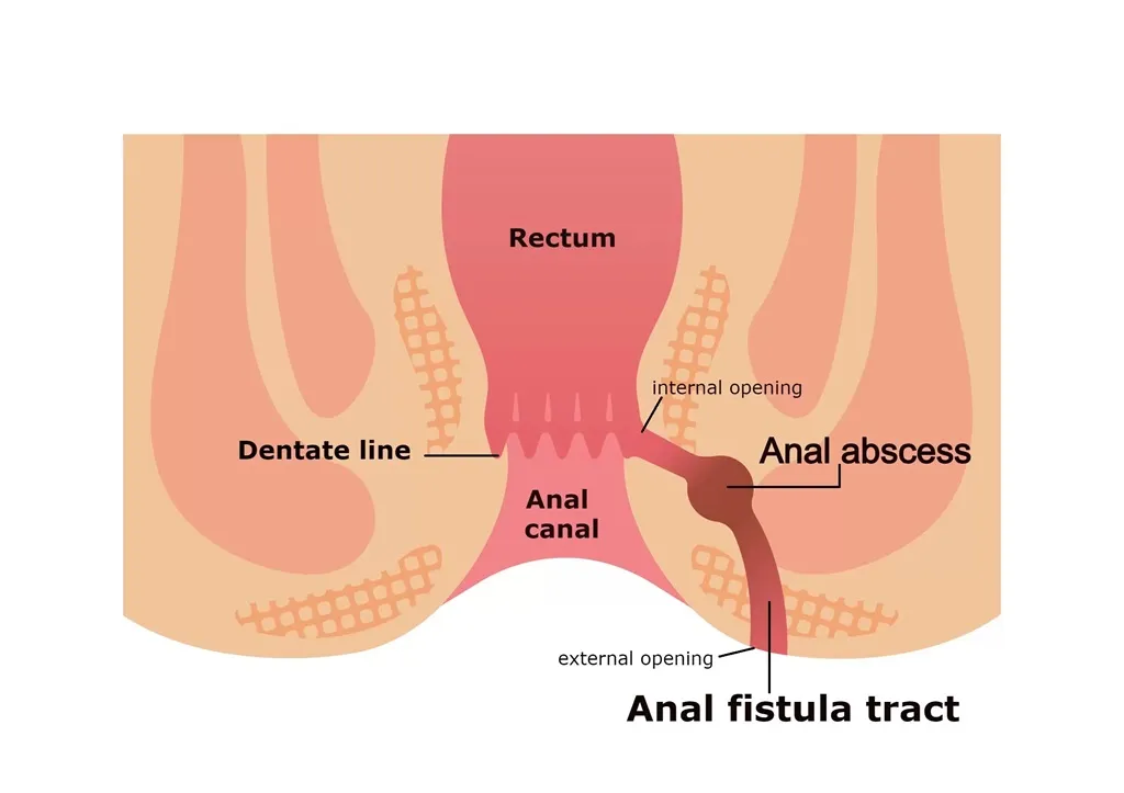 Laser Fistula Surgery in Hyderabad