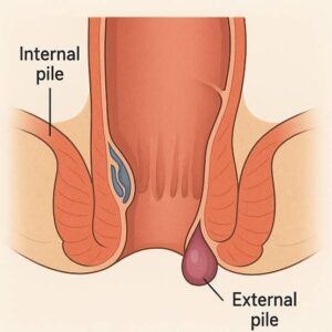 How to reduce piles without operation?
