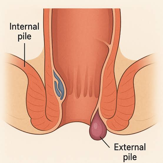 How to reduce piles without operation?