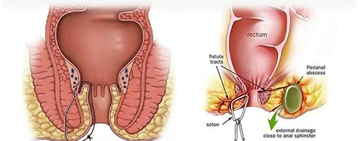 Cost of Fistula Laser Surgery in Hyderabad 2026