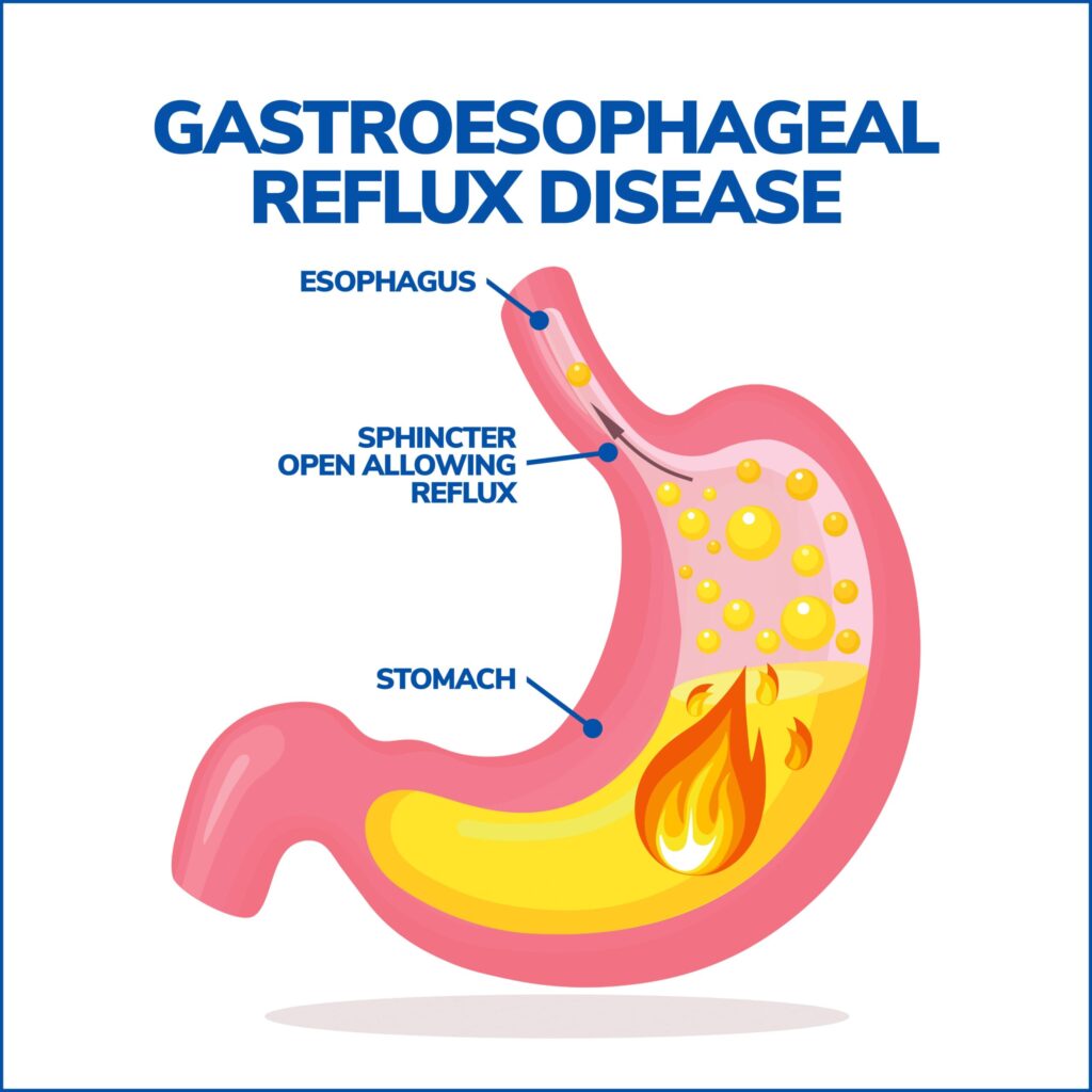 Gastroesophageal Reflux Disease Care in Hyderabad 